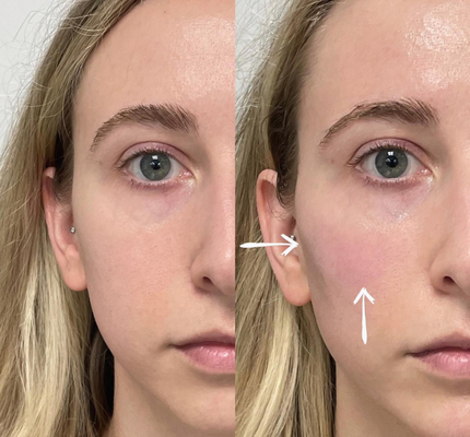 Riempitori cutanei acidi ialuronici profondi delle labbra 2ml di Skinject iniettabili