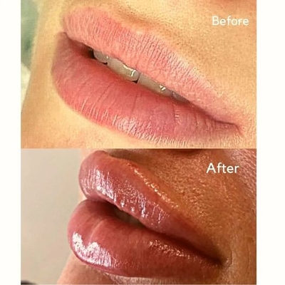 Iniezione iniettabile Juvederms del riempitore un riempitore cutaneo da ultra 3 ha per il volume del labbro