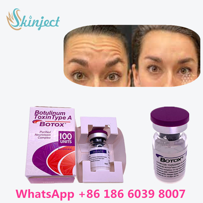 La tossina botulinica originale  100u di 100% per rimuove le grinze