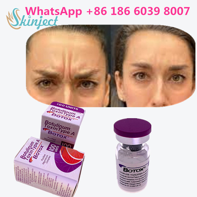 La tossina botulinica originale  100u di 100% per rimuove le grinze