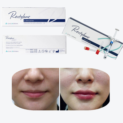 Vital  Perlane Cross Linked Dermal Filler Acido ialuronico