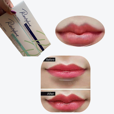 2*1 ml/ scatola Riempitore cutaneo a collegamento croce per l' ingrandimento delle labbra