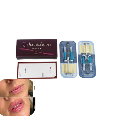 Juvederm filler cutaneo per le labbra filler per l' iniezione di acido ialuronico