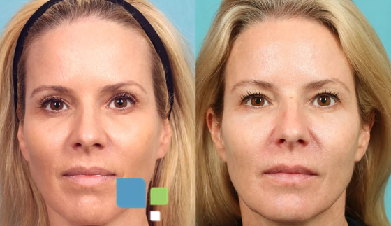 3D PLLA filler iniettabile per la rigenerazione del collagene facciale