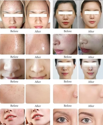 Nuovo arrivo Perla Nera 10 in 1 Hydra Peeling Machine Microdermabrasion Machine Facial Spa Micro-Touch Hydra Skin Care