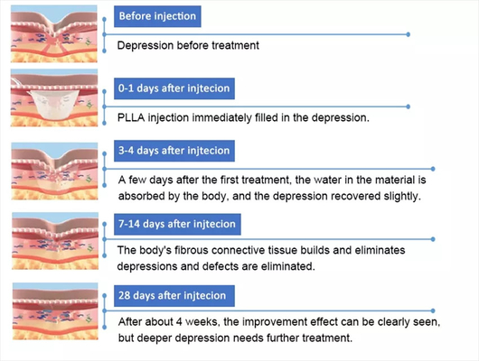 PLLA Acido poli- L- lattico per iniezione facciale 10 flaconcini 150 mg