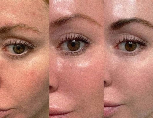 Stimolazione del collagene Profhilo Riempitore Dermico Iniettabile Five Point Lifting