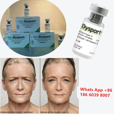 Dysport 500u Tossina Botulinica di Tipo A per il Rimodellamento delle Guance