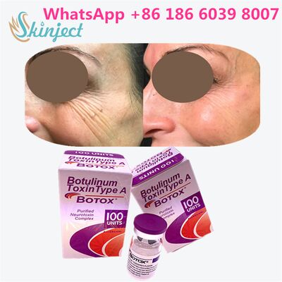 Allergan Botox Botulinum Toxin Tipo A 100 unità per la rimozione delle rughe con una durata di 4~6 mesi