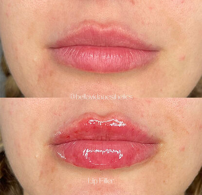 Durata di conservazione 2 anni Gel iniettabile per riempimento cutaneo progettato per la riduzione delle rughe, il contorno facciale e la rivitalizzazione della pelle