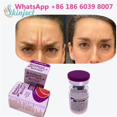 Tossina botulinica BOTOX Cosmetico 100 Unità Allergano OnabotulinumtoxinA per le rughe facciali