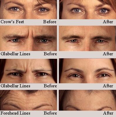Hyamely Premium Botulinum Toxin Tipo A per Iniezione