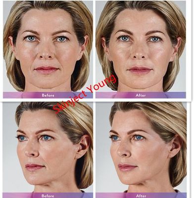 Riempitori iniettabili acidi ialuronici del gel di Juvederm Voluma 2x1ml