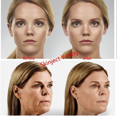 Riempitori iniettabili acidi ialuronici del gel di Juvederm Voluma 2x1ml
