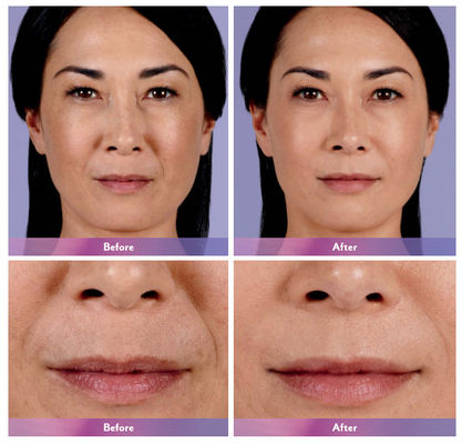 Iniezione cutanea ultra 4 del labbro del riempitore di Juvederm per l'ingrandimento del labbro