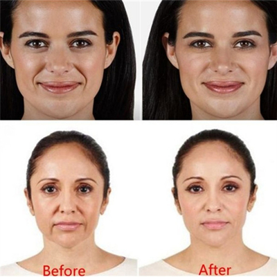 Iniezione cutanea acida ialuronica di Juvederm ha del riempitore del derma di plastica per le signore