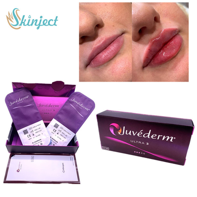 Riempitore cutaneo Nasolabial Juvederm acido ialuronico Ultra3 delle labbra 2x1ml dei popolare