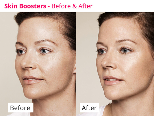 Pelle che ringiovanisce il siero meso di PDRN Skinbooster per rigenerazione del collagene
