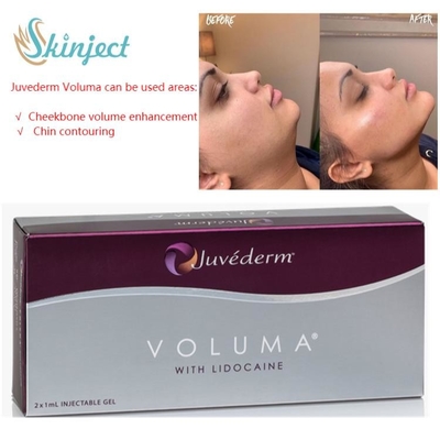 Riempitori cutanei acidi ialuronici di Juvederm Voluma 2x1ml per lo zigomo