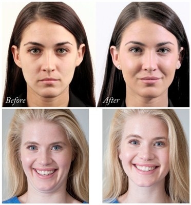 Riempitore facciale acido ialuronico di Juvederms Voluma per l'aumento della guancia e di Chin