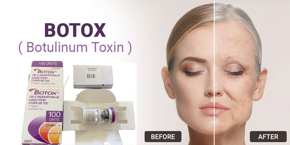 tipo della tossina botulinica di 100Units Allergan un'iniezione per rimozione facciale della grinza