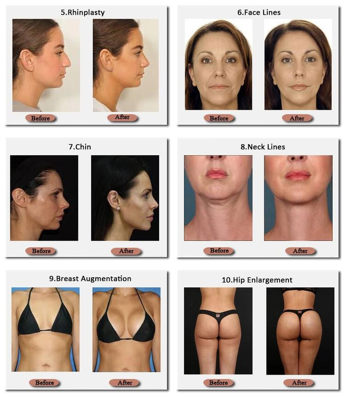 Skinjection riempitore ialuronico Technnology coreano del seno ml da 20 e da 10 ml 24 mg/ml