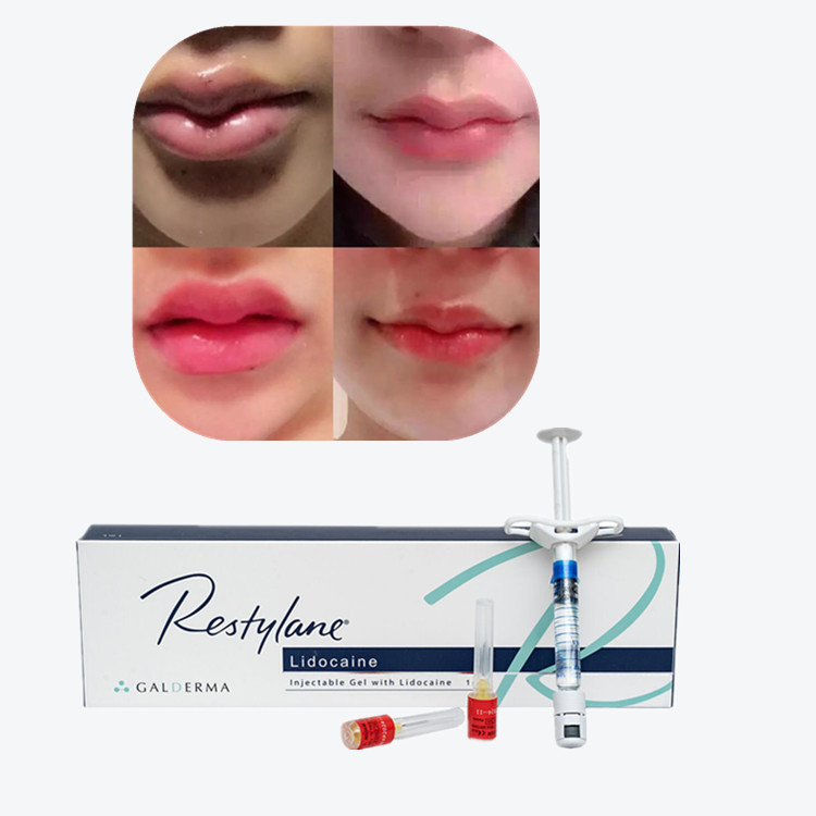 Juvederm Cross Linked Injectable Dermal Filler per le labbra