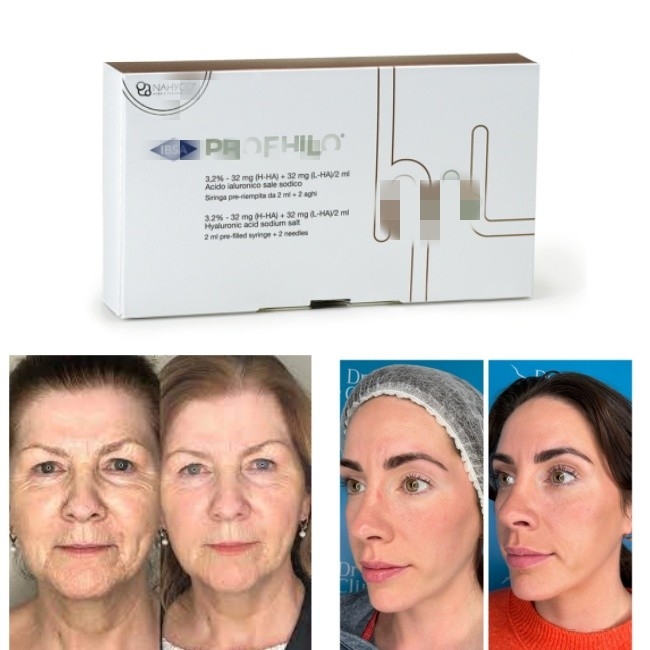 Ago di sollevamento a 5 punti dall'aspetto naturale Filler dermico iniettabile Profhilo
